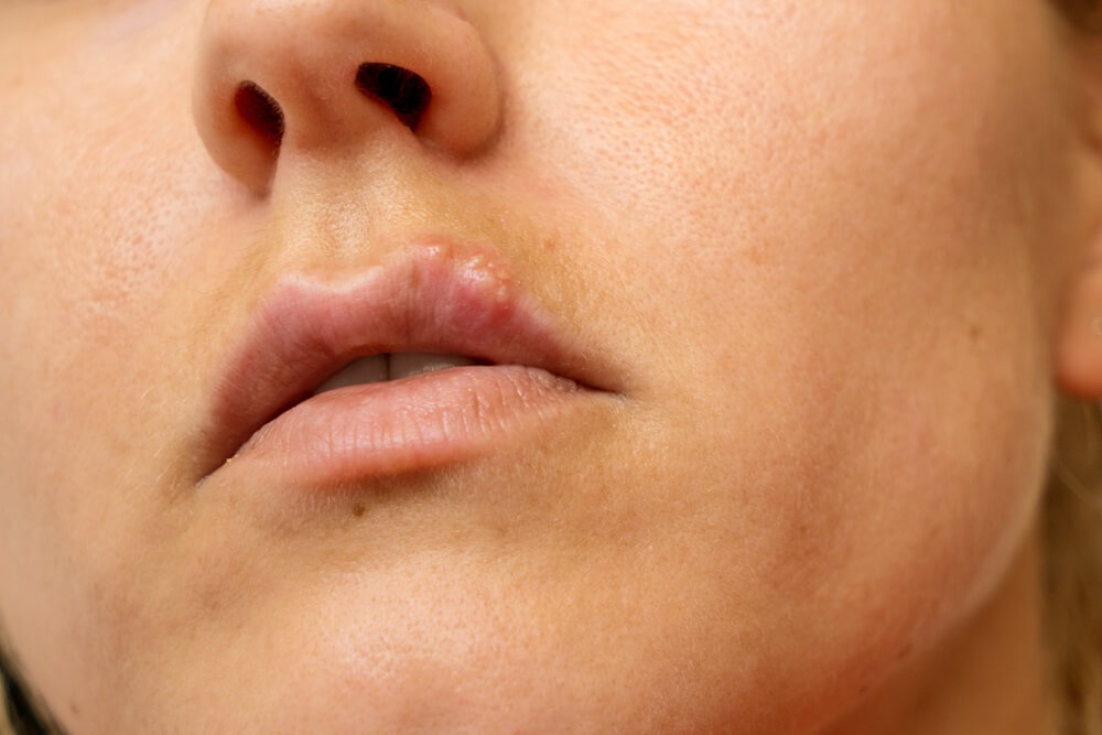 What Are The Tiny Bumps On Lips And How To Treat Them?