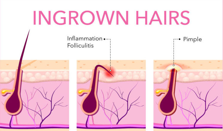 ingrown hair and pimple difference