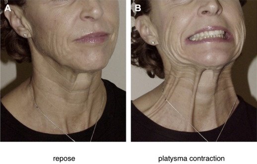 platysma exercise for double chin